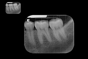 Radiografía periapical