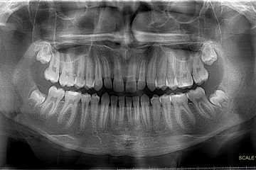 Radiografías extraorales
