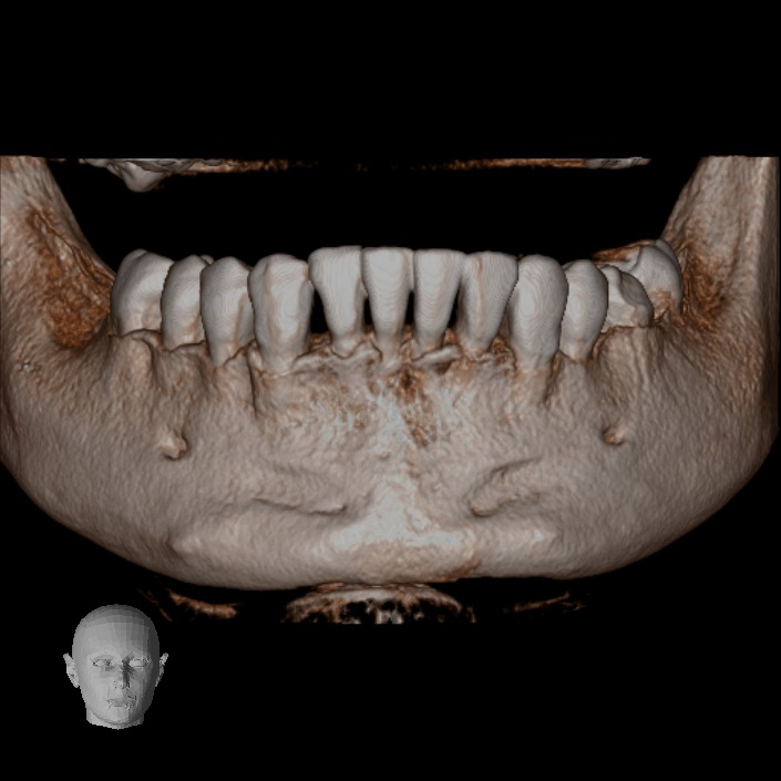 Tomografía CBCT 1